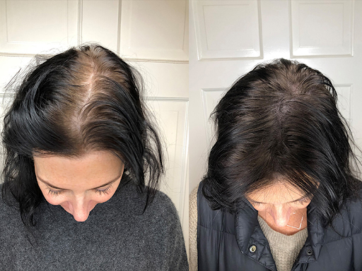 What are the Causes and Solutions for Sudden Hair Loss in Women